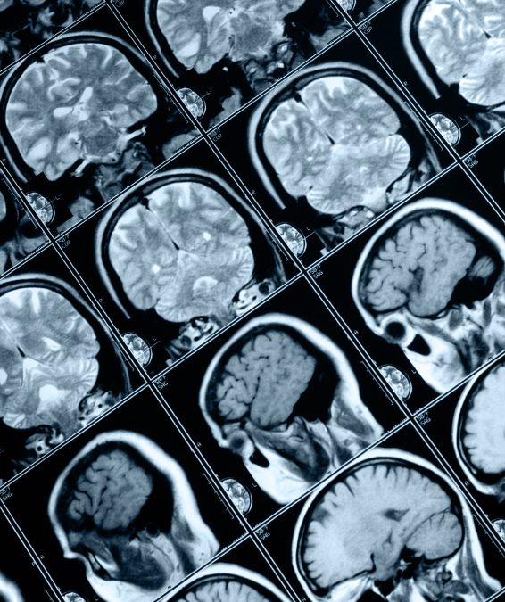 Un implant cérébral réduit les TOC et l’épilepsie