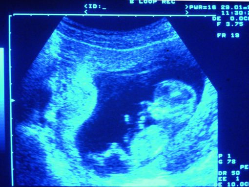 Spina Bifida : une greffe de cellules souches in utero